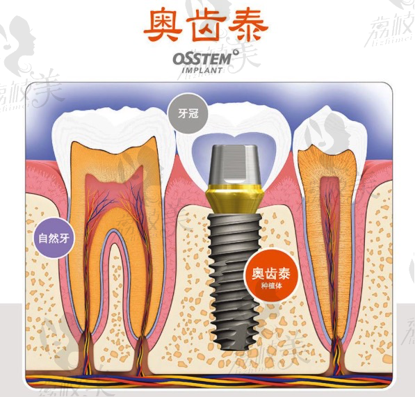 韩国奥齿泰种植体怎么样？