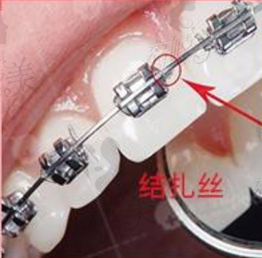 北京圣贝口腔金属矫正结扎丝材料