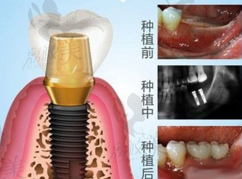 南京金伯利种植院长徐伟科普种植牙整个过程需要多久