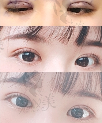韩国心动整形术后1-2个月恢复过程