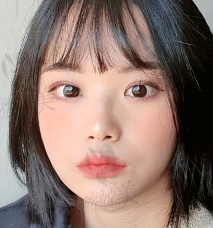 韩国心动整形1个月左右复查