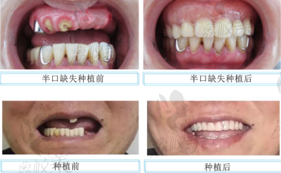 李江明博士种植牙案例