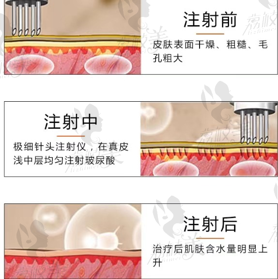 合肥恒美韩国进口东国水光神器3