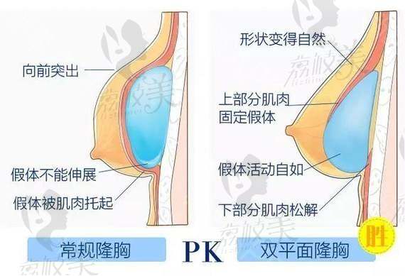 双平面假体隆胸和常规隆胸比较