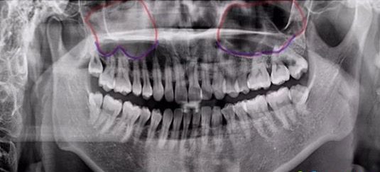 易继恩上颌窦内提升术种植牙