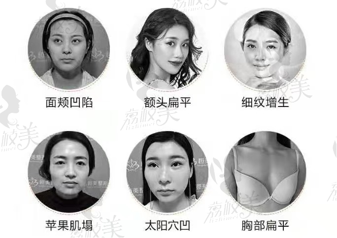 合肥恒美自体脂肪填充