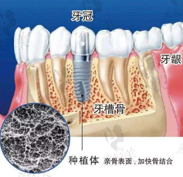 北極星口腔周巖主任種植牙的三大優(yōu)勢(shì)