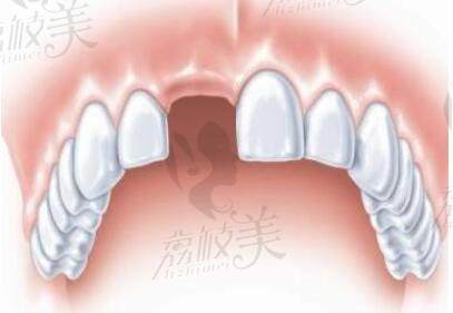 牙齿缺失会影响颜值和健康