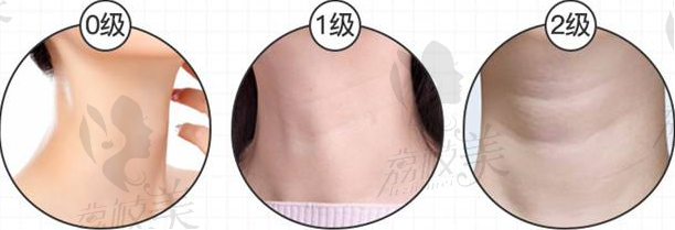 颈部皮肤等级逐渐加深