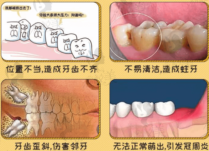 智齿疼的症状