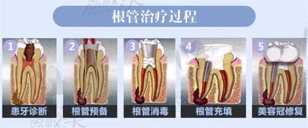 合肥维多利亚根口腔管治疗