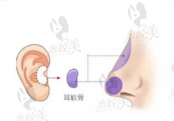 耳软骨取出