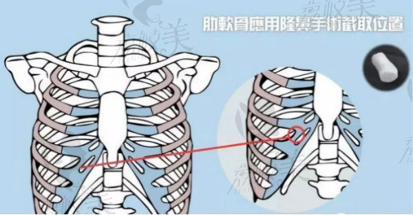 肋软骨取出过程