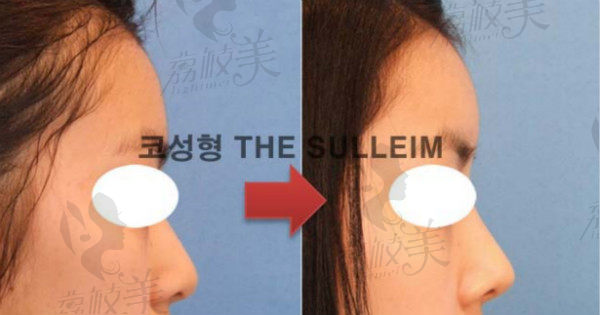 韩国心动整形假体+耳软骨案例