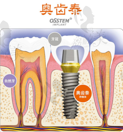成都军大奥齿泰种植体