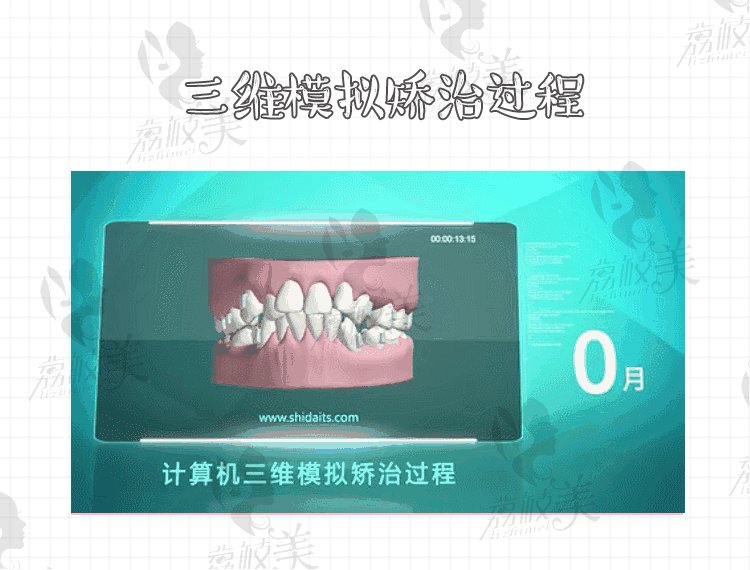 广州好大夫口腔三维模拟矫正过程