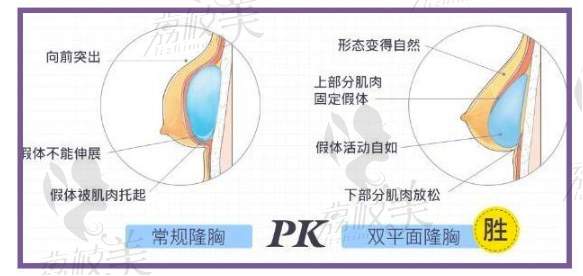 常规隆胸和双平面隆胸对比