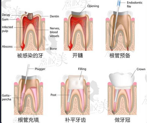 广州艺美根管治疗＋全冠