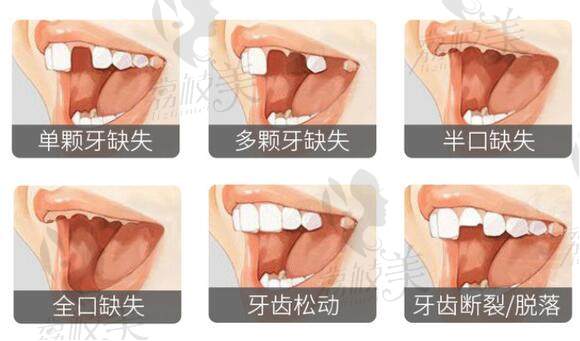 北京地区口腔种植那个医院好