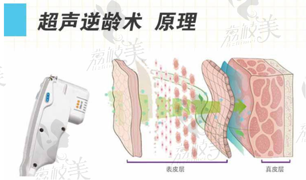 超声提升原理