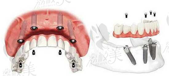 北京维嘉口腔All-on-4即刻负重技术适应人群有哪些？