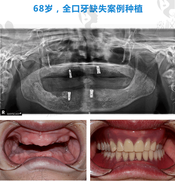 北京维嘉口腔刘慧霞院长做ALL-ON-4种植牙技术真实案例分享