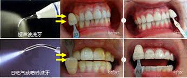EMS洗牙与超声波洗牙对比