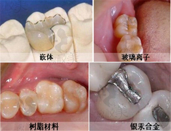补牙材料术后效果对比