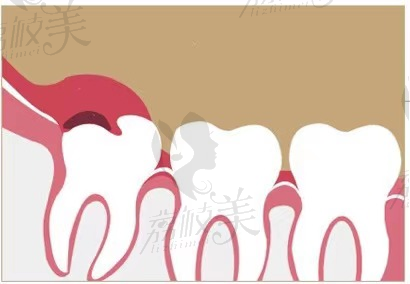 龙海海澄齿恒口腔关于3种智齿应立即拔除的科普及危害