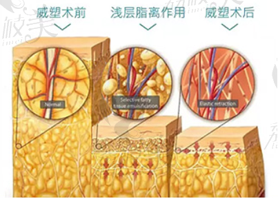 威塑吸脂效果