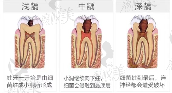 三明皓臣瑞尔口腔的几种牙龋齿程度