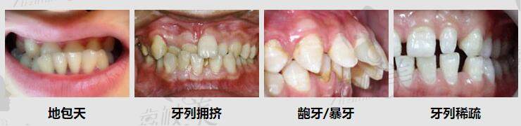 生活中各種需要進(jìn)行矯正的牙齒類型