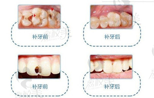 美陽口腔補牙