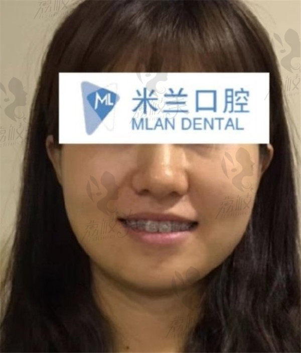 刚戴上牙套