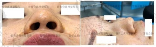 硅胶隆鼻会感染!深圳贝加美复杂鼻2次修复6个月后真实事件!