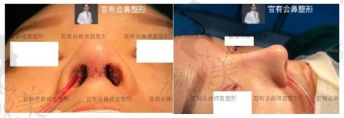 硅胶隆鼻会感染!深圳贝加美复杂鼻2次修复6个月后真实事件!