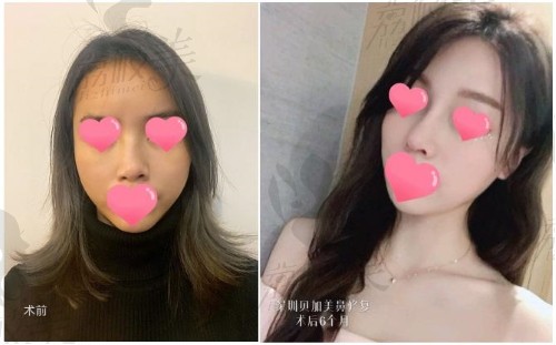 深圳贝加美医疗美容医院主任医师官有会复杂鼻修复对比图