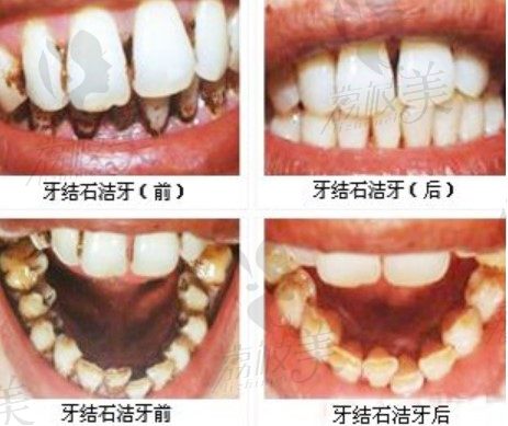 惠州愛雅仕口腔單人氣動力潔牙案例