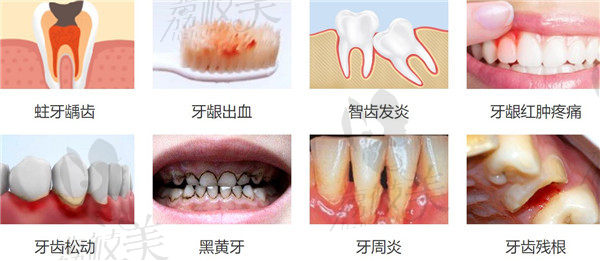 牙齿龋坏对口腔的影响