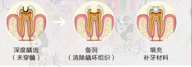 杭州亮贝美口腔医院美国进口树脂补牙