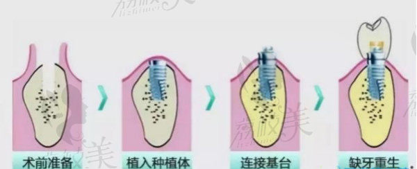 3D生钛种植技术过程