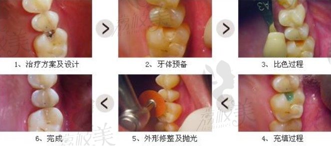 珠江口腔补牙过程
