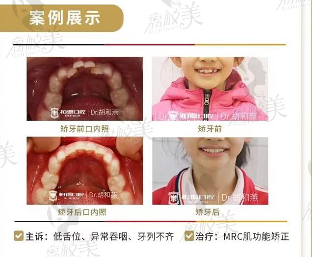 mrc肌功能矫正
