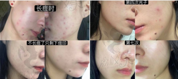 北京泽尔医疗美容皮肤科主任张蕾案例