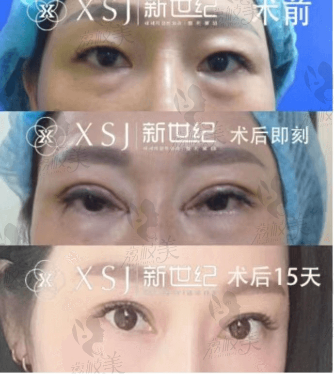 福州鼓楼新世纪整形——PARK双眼皮案例