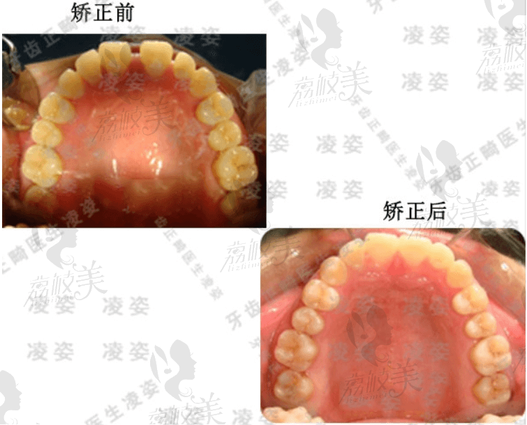 上海圣贝凌姿医生顾客上排牙矫正前后对比图
