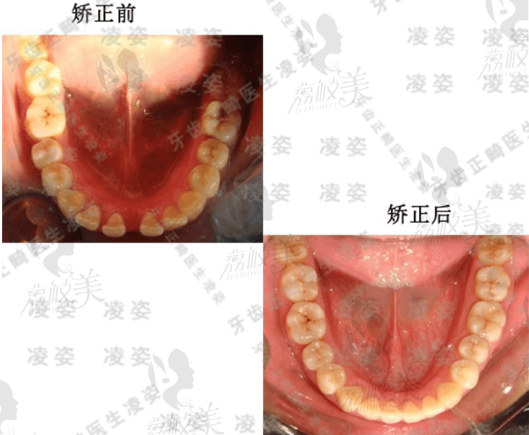 上海圣贝凌姿医生顾客下排牙矫正前后对比图