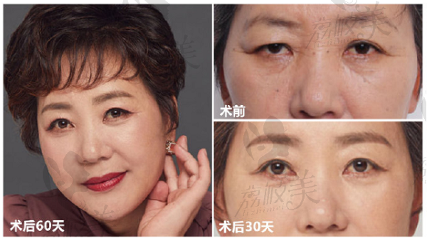 北京张菡丽格医疗美容张菡院长衰老型眼周年轻化手术效果对比