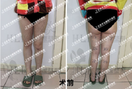 北京禾力康医疗美容金尚训HLk腿不等粗美学矫正前