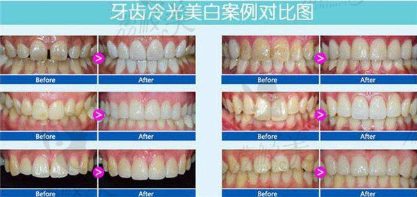 莆田群益口腔冷光美白案例